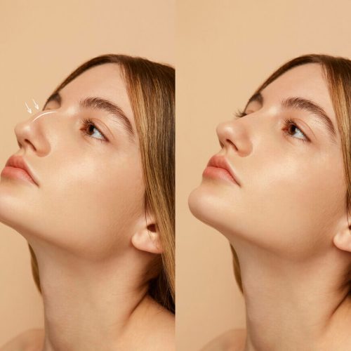 Cuánto vale una rinoplastia en Colombia